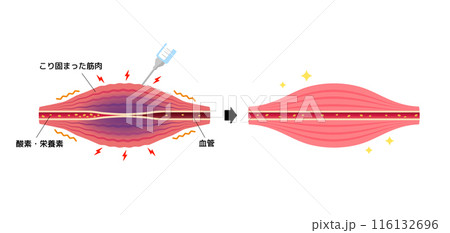 ボトックス注射 (ボツリヌストキシン）によるこりの緩和のメカニズム / ベクター図解イラスト 116132696