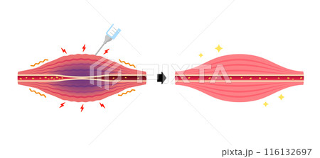 ボトックス注射 (ボツリヌストキシン）によるこりの緩和のメカニズム / ベクター図解イラスト 116132697