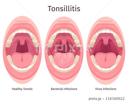 Tonsils. Human sore throat airways inflammation tonsil lymph and tongue in open mouth, bacteria swollen glands pharyngitis tonsillolith disease symptom, swanky illustration 116160022