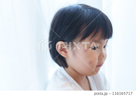 顔を虫刺された子供 116165717