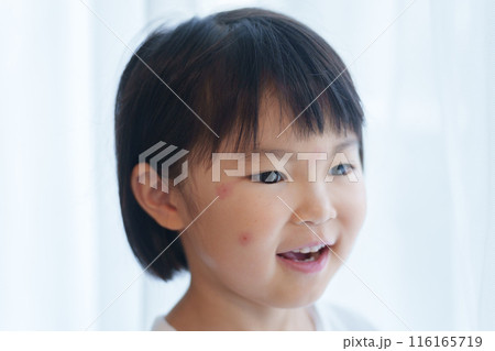 顔を虫刺された子供 顔を虫刺された子供 116165719