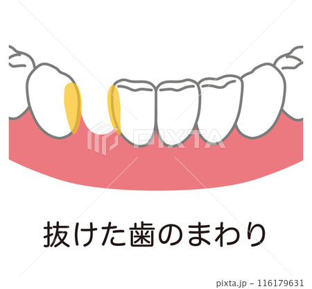 抜けた歯のまわりまわりに溜まった歯垢　歯磨き　磨き残し 116179631
