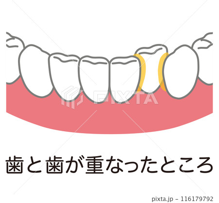 歯と歯が重なったところに溜まった歯垢 歯磨き 磨き残し 歯と歯が重なったところに溜まった歯垢 歯磨き 磨き残し 116179792
