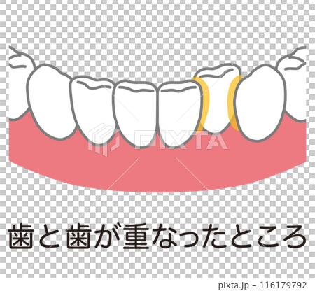 歯と歯が重なったところに溜まった歯垢 歯磨き 磨き残し 歯と歯が重なったところに溜まった歯垢 歯磨き 磨き残し 116179792