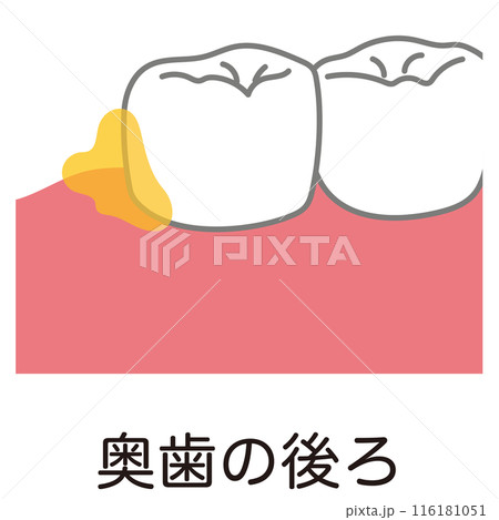 奥歯の後ろに溜まった歯垢 歯磨き 磨き残し 奥歯の後ろに溜まった歯垢 歯磨き 磨き残し 116181051