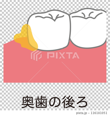 奥歯の後ろに溜まった歯垢 歯磨き 磨き残し 奥歯の後ろに溜まった歯垢 歯磨き 磨き残し 116181051