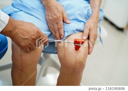 Doctor neurologist testing reflex knee with hammer and show Asian senior scars surgical total knee joint replacement. 116190806
