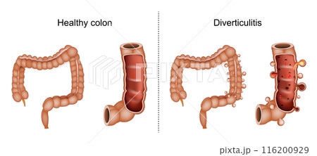 Diverticulitis. Comparison and difference between a healthy intestine and Colonic diverticulitis 116200929