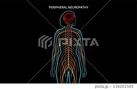 Peripheral neuropathy medical poster Peripheral neuropathy medical poster 116201505