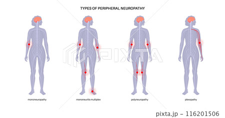 Peripheral neuropathy medical poster 116201506