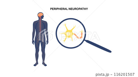 Peripheral neuropathy medical poster Peripheral neuropathy medical poster 116201507