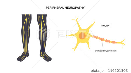 Peripheral neuropathy medical poster Peripheral neuropathy medical poster 116201508