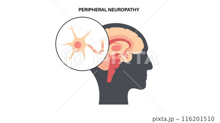 Peripheral neuropathy medical poster 116201510