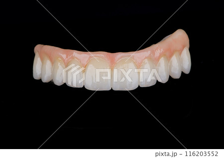 Two stages of making full dental zirkonium prosthesis on titanium bar. Raw before sintering and layered or painted zirkonium. 116203552