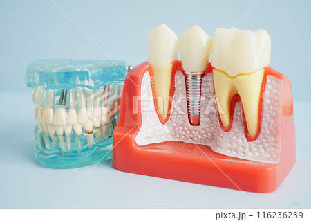 Dental implant, artificial tooth roots into jaw, root canal of dental treatment, gum disease, teeth model for dentist studying about dentistry. Dental implant, artificial tooth roots into jaw, root canal of dental treatment, gum disease, teeth model for dentist studying about dentistry. 116236239