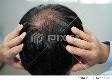 Bald head in man, hair loss treatment health problem. Bald head in man, hair loss treatment health problem. 116236478