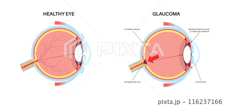 Glaucoma eye disease Glaucoma eye disease 116237166