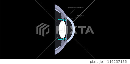 Glaucoma eye disease Glaucoma eye disease 116237186