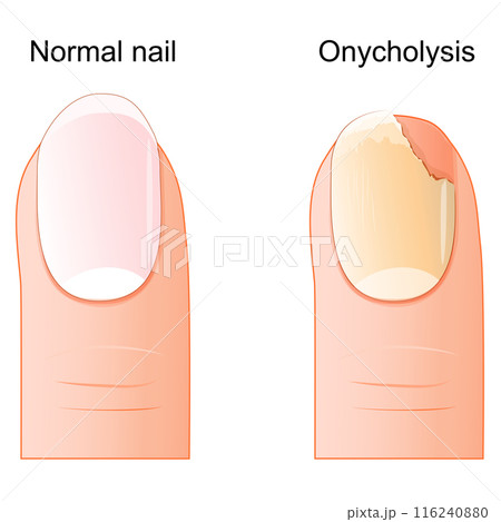 Onycholysis. detachment of the nail plate 116240880