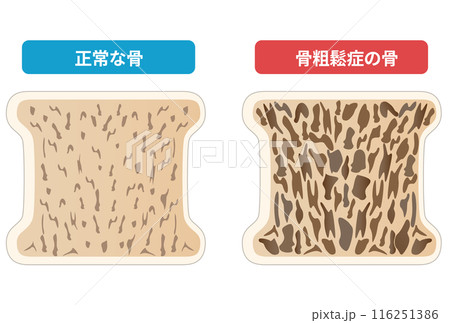 骨粗鬆症と正常な骨の断面図の比較 116251386