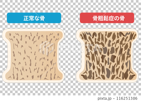 骨粗鬆症と正常な骨の断面図の比較 116251386
