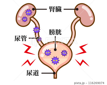シンプルな膀胱炎の図解イラスト素材 116269074