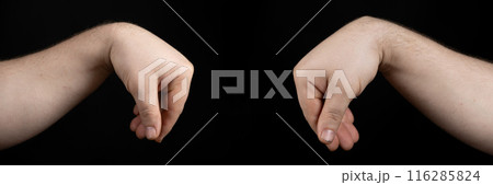 Comparison of healthy arm and arm with wrist ganglion cyst on black background. Comparison of healthy arm and arm with wrist ganglion cyst on black background. 116285824