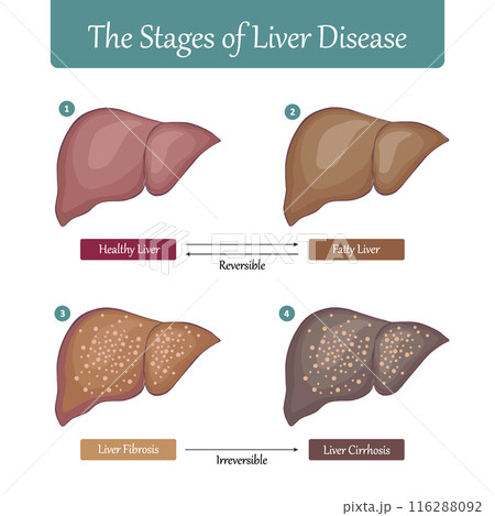 Stages of Liver Damage flat vector illustration. Stages of Liver Damage flat vector illustration. 116288092