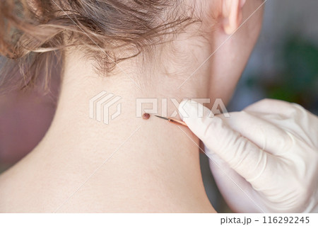 Woman examing her abnormal mole. Dermatology procedure. Doctor checking 116292245