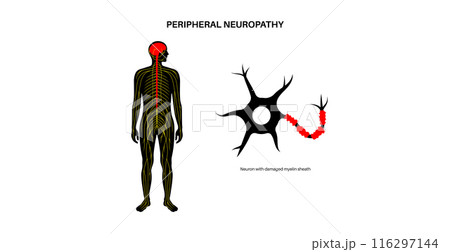 Peripheral neuropathy medical poster 116297144