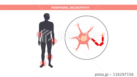 Peripheral neuropathy medical poster 116297156