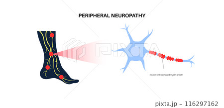 Peripheral neuropathy medical poster 116297162