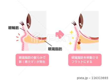 目のくま（黒クマ) の除去手術 図解イラスト (ハムラ法・裏ハムラ法) 116313693
