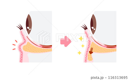 目のくま(黒クマ) の除去手術 図解イラスト (ハムラ法・裏ハムラ法) 目のくま(黒クマ) の除去手術 図解イラスト (ハムラ法・裏ハムラ法) 116313695