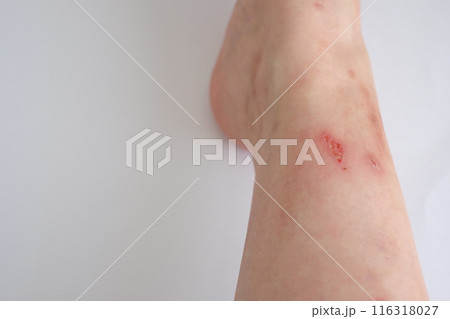 40代女性の右足のかさぶた 116318027