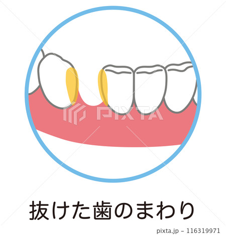 抜けた歯のまわりまわりに溜まった歯垢 歯磨き 磨き残し 抜けた歯のまわりまわりに溜まった歯垢 歯磨き 磨き残し 116319971