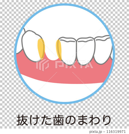 抜けた歯のまわりまわりに溜まった歯垢 歯磨き 磨き残し 抜けた歯のまわりまわりに溜まった歯垢 歯磨き 磨き残し 116319971