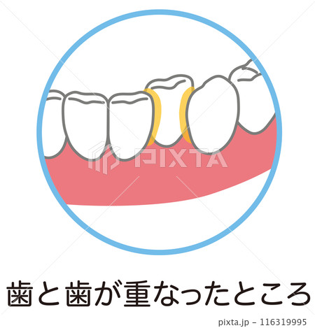 歯と歯が重なったところに溜まった歯垢 歯磨き 磨き残し 歯と歯が重なったところに溜まった歯垢 歯磨き 磨き残し 116319995