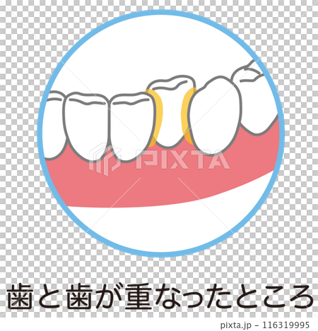 歯と歯が重なったところに溜まった歯垢 歯磨き 磨き残し 歯と歯が重なったところに溜まった歯垢 歯磨き 磨き残し 116319995