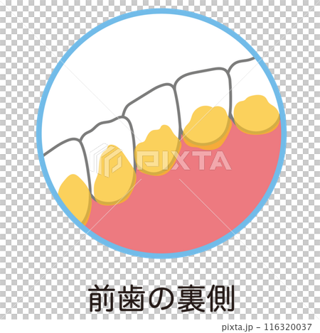 Plaque accumulated on the back of the front teeth, toothbrushing, unbrushed areas 116320037
