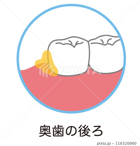 奥歯の後ろに溜まった歯垢　歯磨き　磨き残し 116320060