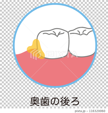 奥歯の後ろに溜まった歯垢　歯磨き　磨き残し 116320060