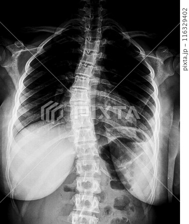X-ray of idiopathic scoliosis of thoracic spine. Part of adolescent skeleton with spinal curvature on black background. Lateral backbone deformation. Radiological anatomy image 116329402