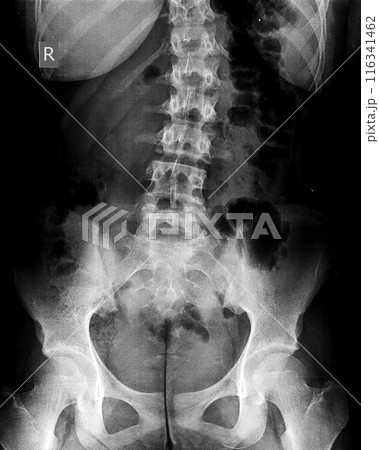 X-ray of idiopathic scoliosis of lumbar spine. Part of adolescent skeleton with spinal curvature on black background. Lateral backbone bending. Radiological anatomy image of lower back and pelvis 116341462
