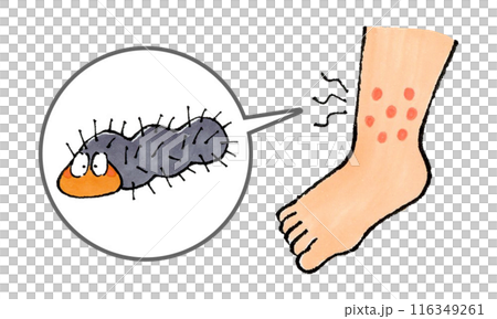 腳被毛毛蟲咬了 116349261