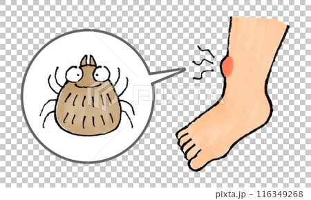 腿被蜱蟲咬了 116349268