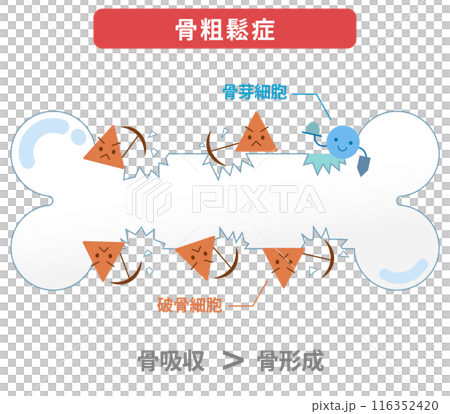 破骨細胞と骨芽細胞のバランスが崩れることにより引き起こされる骨粗鬆症 116352420