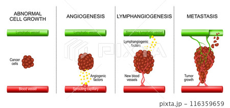 Cancer. Tumor development. Angiogenesis and Metastasis. 116359659