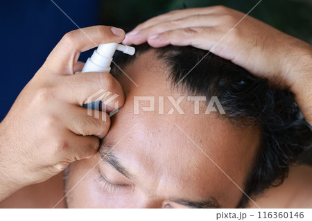 Asian men use serum spray to maintain strong hair and prevent breakage. Man with worry and touching on his head to show a bald head. Hair root nourishment. concept of healthcare, treat, medicine. 116360146