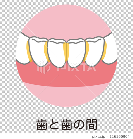 Plaque accumulated between teeth, tooth brushing, brushing residue Plaque accumulated between teeth, tooth brushing, brushing residue 116360904